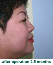 plastic_surgery_augmentation_rhinoplasty